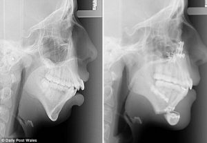 a_transformacao_de_uma_jovem_depois_de_ser_operada_a_mandibula-_nem_parece_a_mesma_pessoa_1
