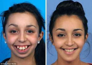 a_transformacao_de_uma_jovem_depois_de_ser_operada_a_mandibula-_nem_parece_a_mesma_pessoa_2
