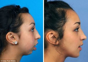 a_transformacao_de_uma_jovem_depois_de_ser_operada_a_mandibula-_nem_parece_a_mesma_pessoa_3